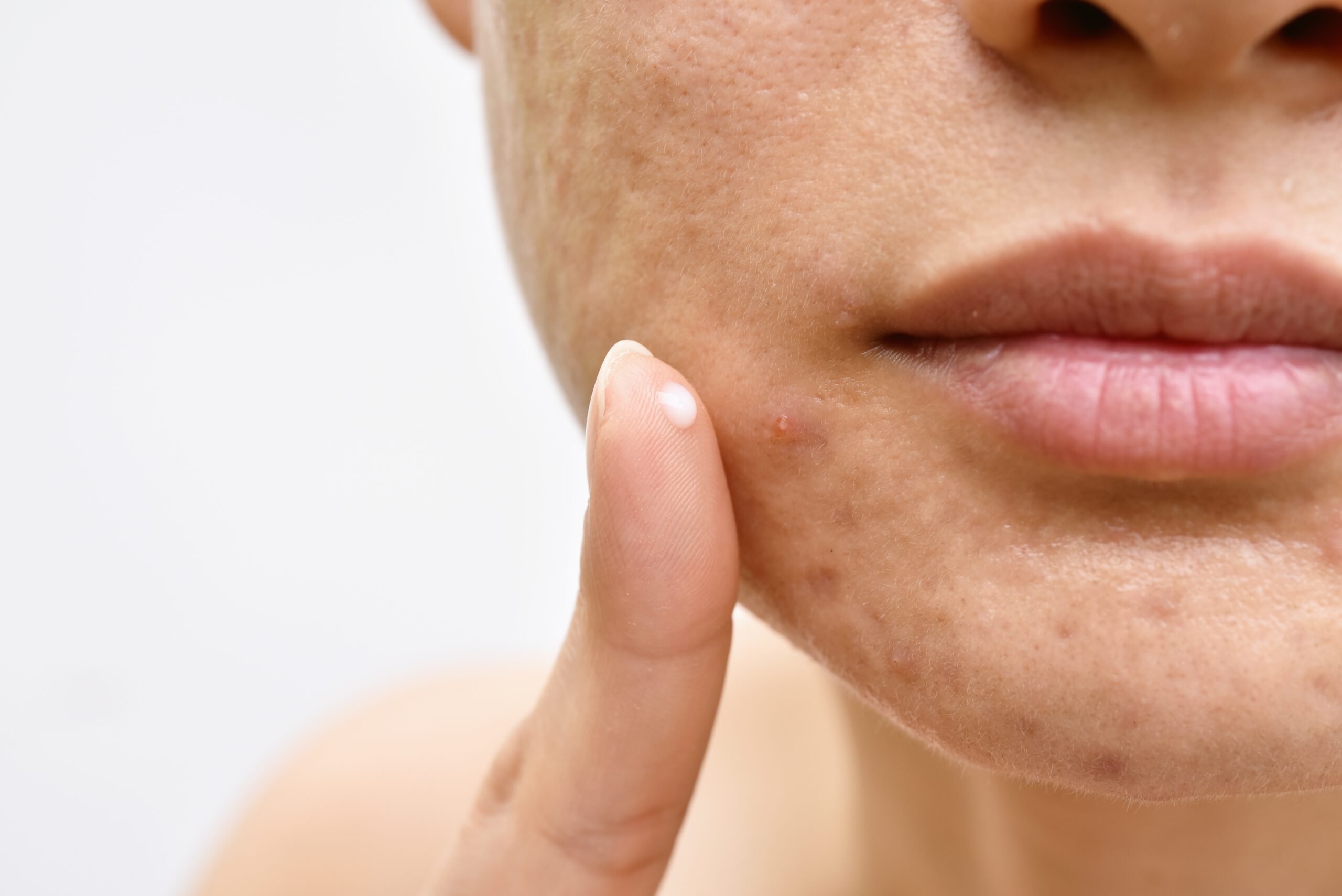 Woman applying acne treatment medication