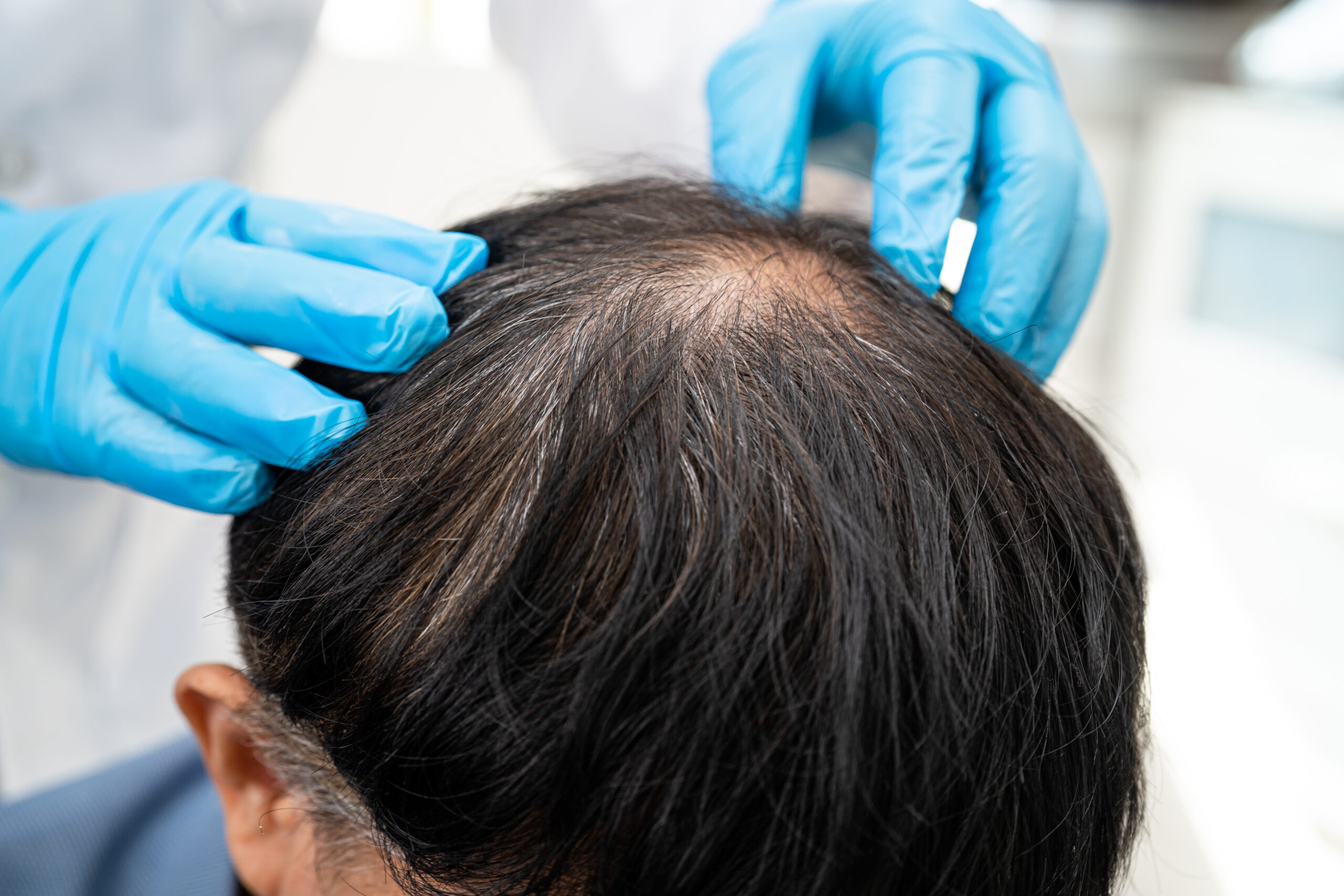 Man receiving hair loss consultation and treatment