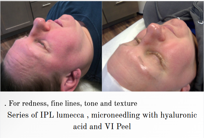IPL photofacial skin treatment before and after