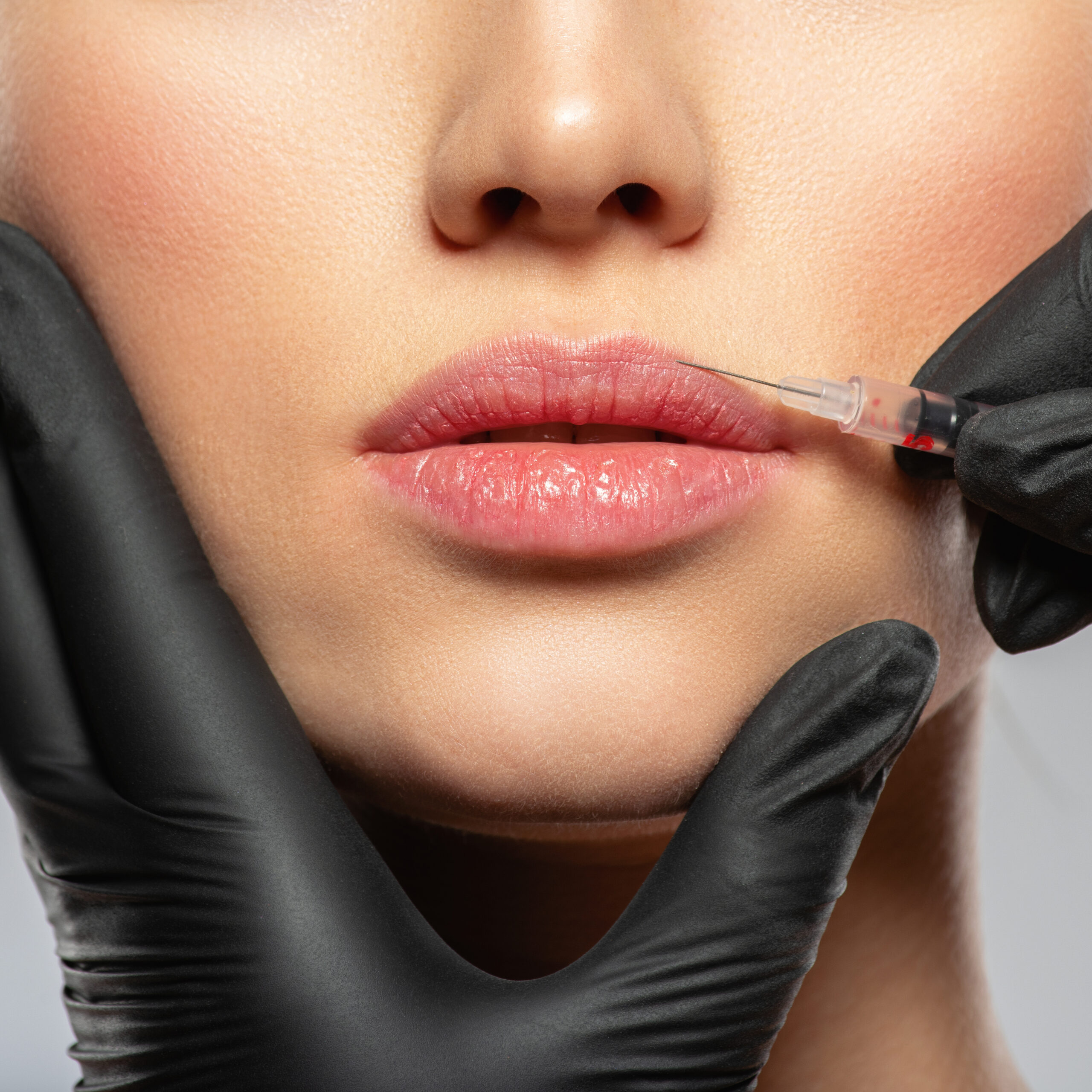 Woman receiving cosmetic lip injection treatment