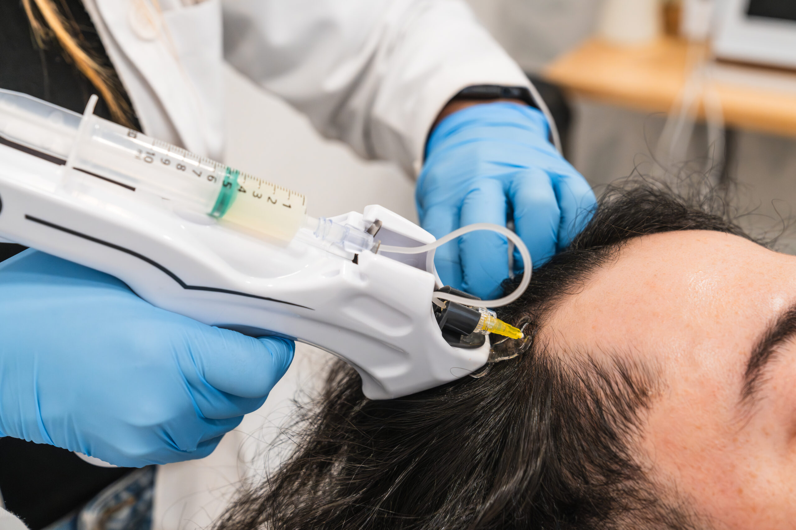 PRP hair restoration scalp injection treatment