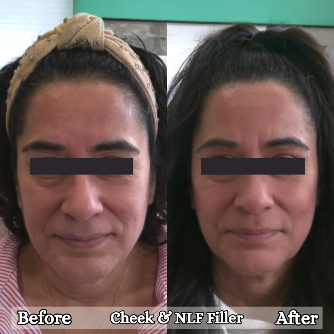 Cheek and nasolabial fold filler before and after results