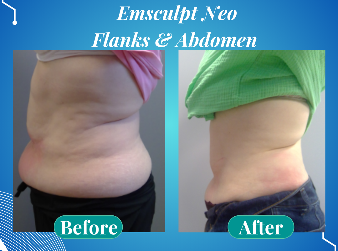 EmSculpt body sculpting treatment results