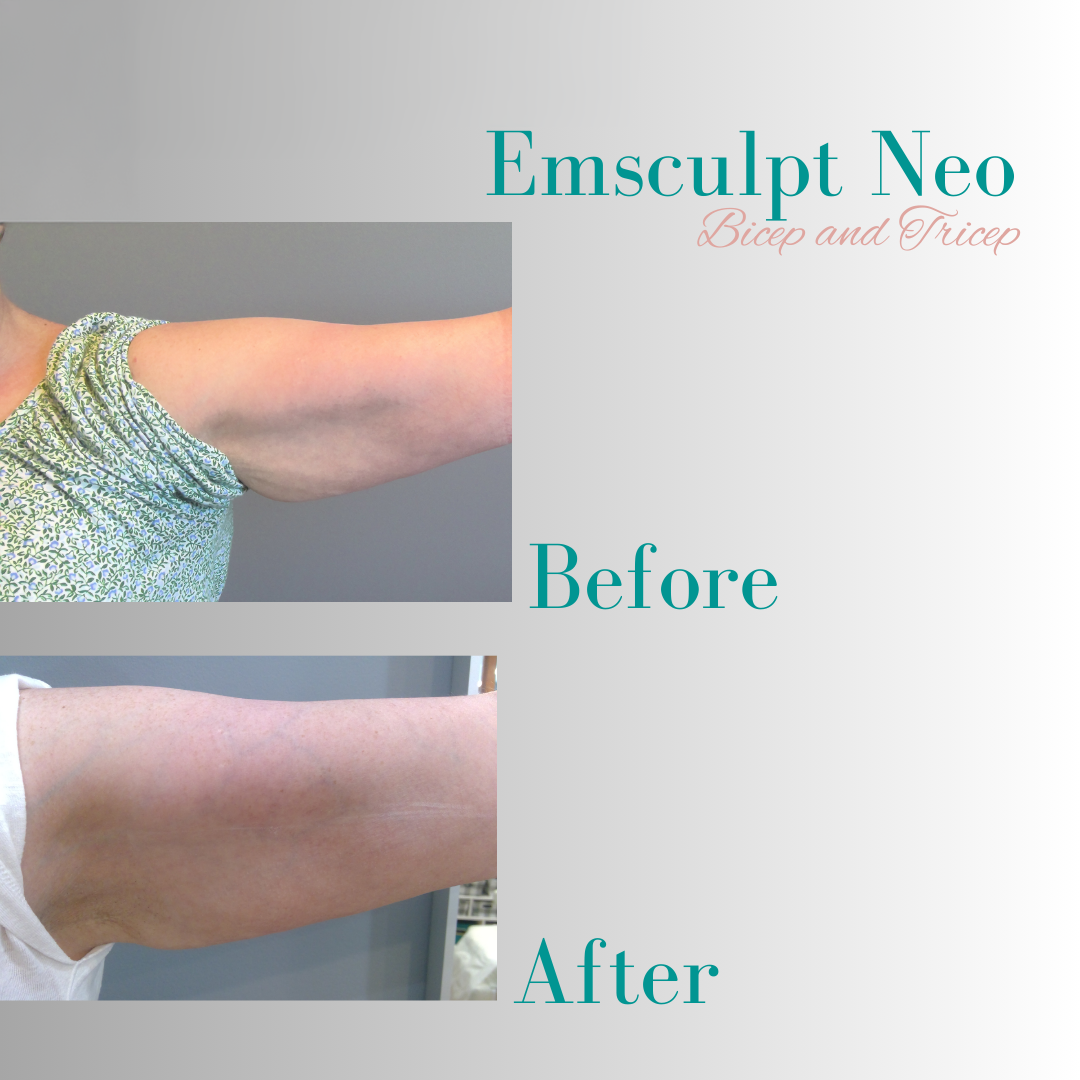 EmSculpt NEO muscle building and fat reduction device