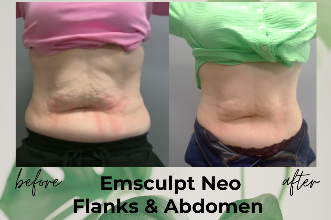 EmSculpt non-invasive body sculpting treatment