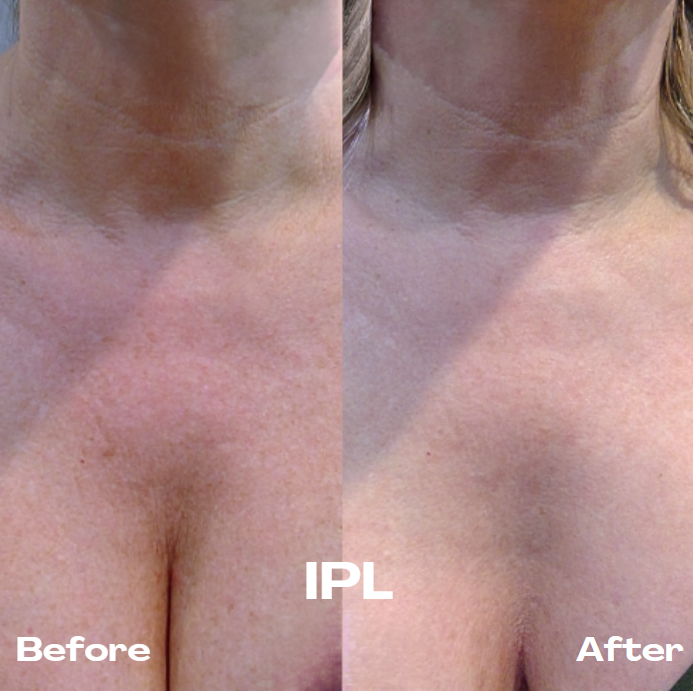 IPL intense pulsed light treatment device