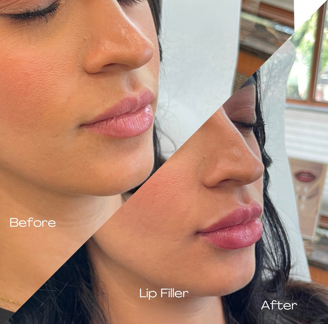 Lip filler before and after results