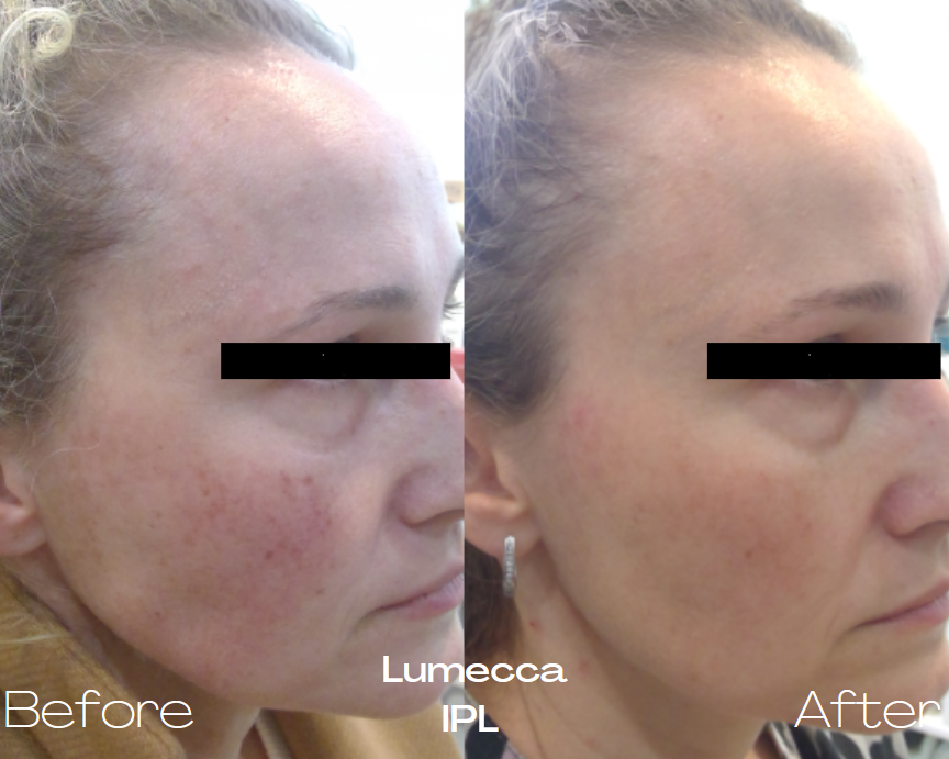 Lumecca IPL skin rejuvenation treatment