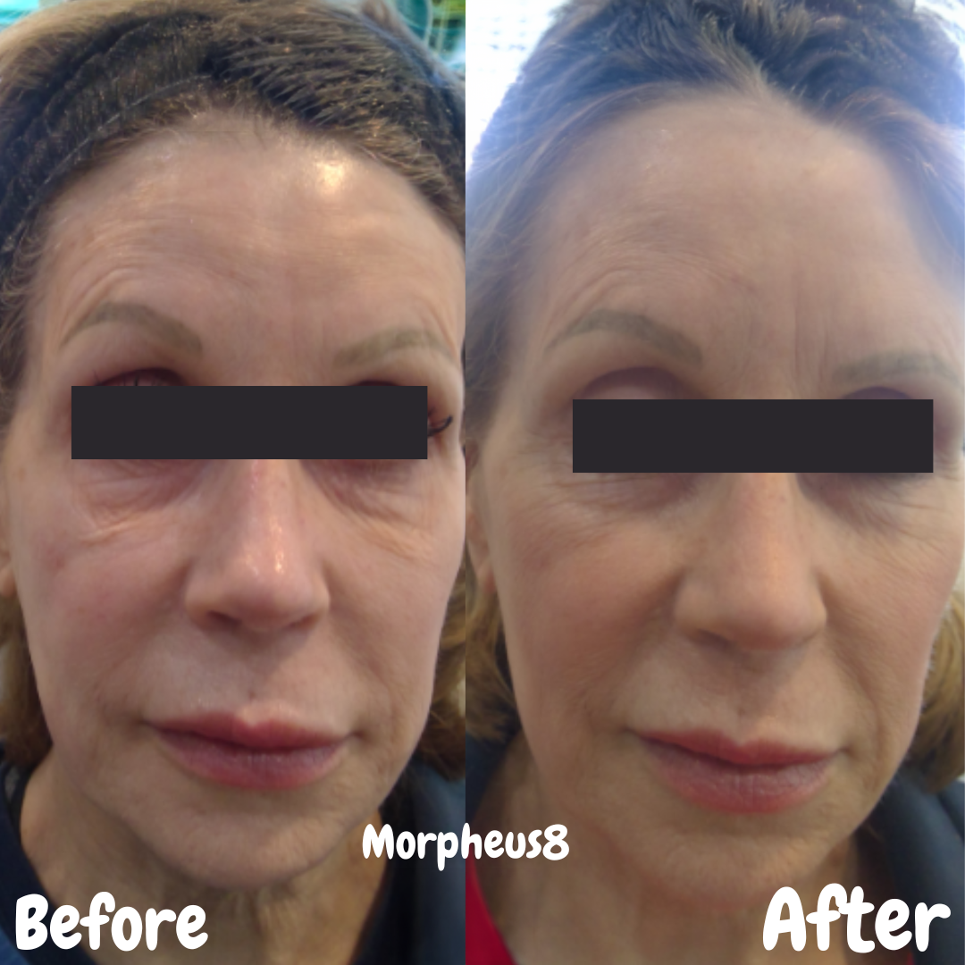 Morpheus8 microneedling radiofrequency results