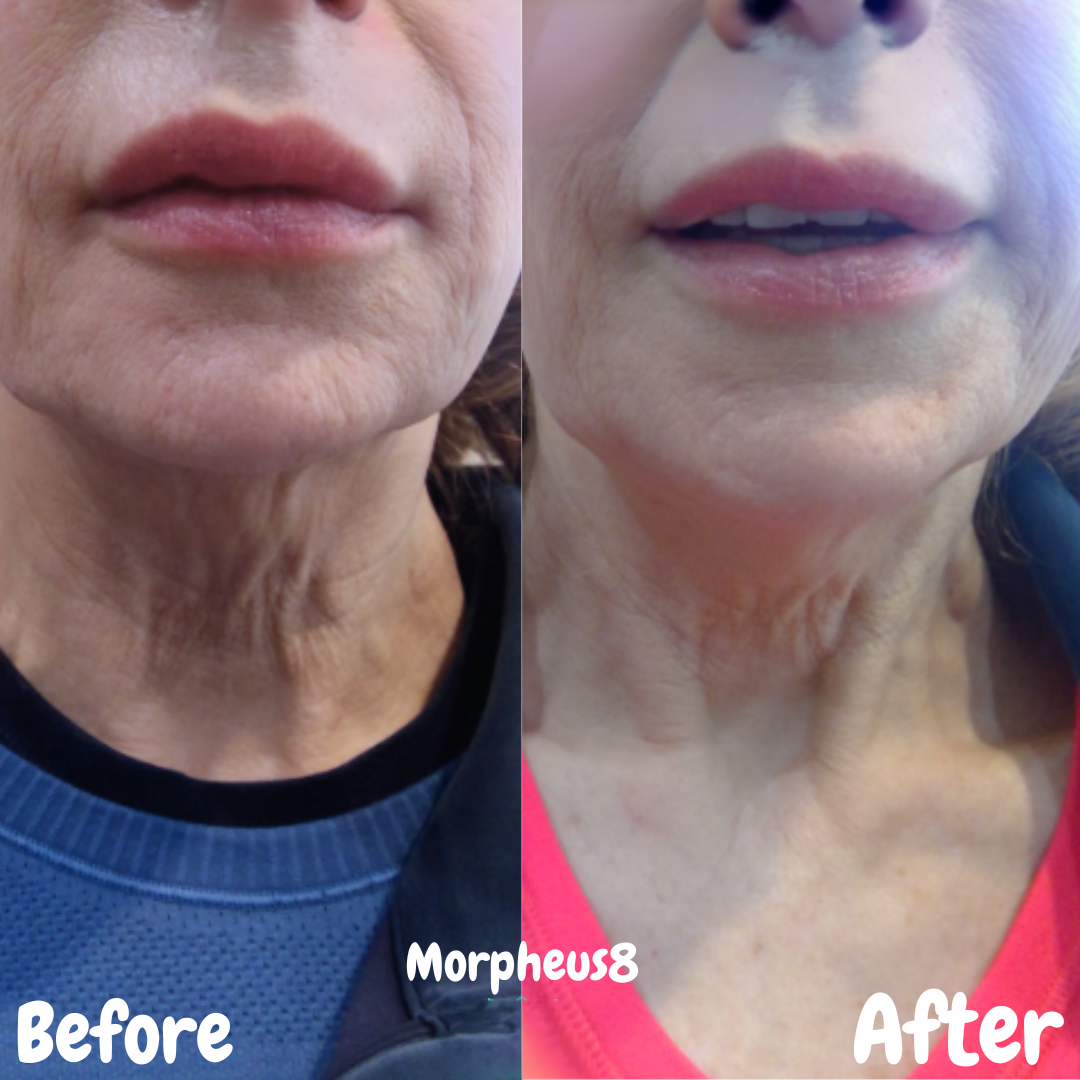 Morpheus8 skin remodeling treatment
